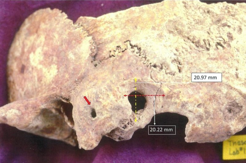 В Греции нашли 1600-летний череп со следами сложной операции на мозге - «Финансы»